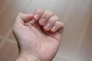 Hands clenched into fists show fingernails and the texture of the hands indicates health problems with the skin. photo
