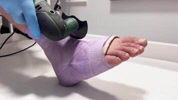 A healthcare worker is carefully cutting through a purple plaster cast on a patient foot with an oscillating cast cutter. video