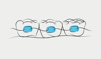 Teeth braces illustration drawing in linear style on white and blue background vector