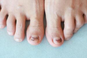 Subungual Hematoma on toenail are injuries of wearing shoes that are too tight in which bleeding develops under the nail. A crush injury to the distal phalanx fingernail or toenail, black toenail. photo