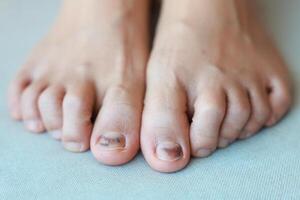 Subungual Hematoma on toenail are injuries of wearing shoes that are too tight in which bleeding develops under the nail. A crush injury to the distal phalanx fingernail or toenail, black toenail. photo