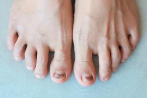 Subungual Hematoma on toenail are injuries of wearing shoes that are too tight in which bleeding develops under the nail. A crush injury to the distal phalanx fingernail or toenail, black toenail. photo