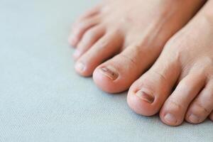 Subungual Hematoma on toenail are injuries of wearing shoes that are too tight in which bleeding develops under the nail. A crush injury to the distal phalanx fingernail or toenail, black toenail. photo