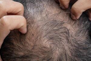 Cropped shot view of Asian man having itching problem on his scalp caused of dandruff. Dandruff is a common scalp condition in which small pieces of dry skin flake off of the scalp. photo