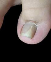 A detached toenail, indicating a fungal nail infection. Onychomycosis, also called Tinea unguium. photo