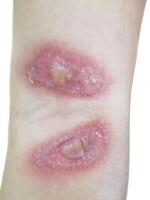 Paederus dermatitis in the arm. It is a peculiar, irritant contact one caused by a beetle photo