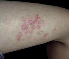 Multiple red blisters on the thigh, indicating a skin irritation or infection photo