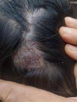 Tinea Capitis or Fungal Infection on the scalp photo