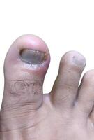 A big toe with paronychia, showcasing swelling and redness near the nail photo