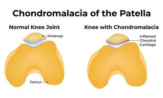 Chondromalacia of the Patella Science Design Illustration Diagram vector