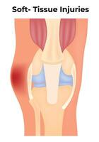 Soft Tissue Injuries Science Design Illustration Diagram vector