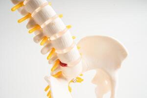 Lumbar spine displaced herniated disc fragment, spinal nerve and bone. Model for treatment medical in the orthopedic department. photo