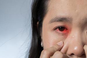 Close up portrait of women with red eye before and after treatment or eye drop. photo
