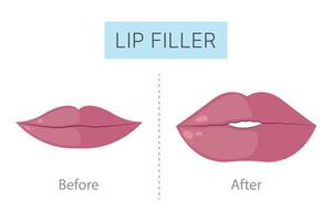 lip filler before and after, realistic 1ml lip filler before and after thin lips vector