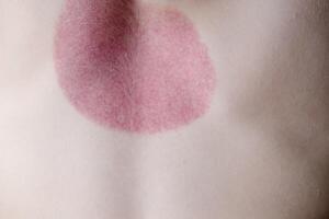 Red spots on the back of a little boy after cupping procedures, rear view. High quality photo
