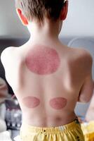 Red spots on the back of a little boy after cupping procedures, rear view. High quality photo