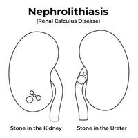 Nephrolithiasis Renal Calculus Disease Science Design Illustration Diagram vector