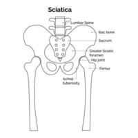 Sciatica Science Design Illustration Diagram vector