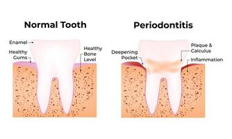 Normal Tooth and Periodontitis Science Design Illustration Diagram vector