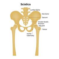 Sciatica Science Design Illustration Diagram vector