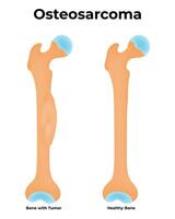 Osteosarcoma Science Design Illustration Diagram vector