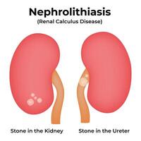 Nephrolithiasis Renal Calculus Disease Science Design Illustration Diagram vector