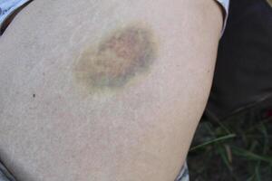Bruise on the leg. A large round bruise of dark blue color on the leg. Skin injuries photo