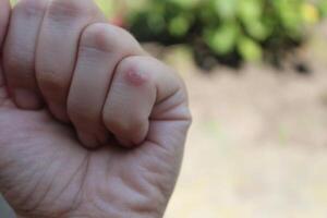 A callus on a finger close-up. Hands that require care photo