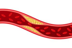 Artery with cholesterol plaque buildup isolated on white background. vector