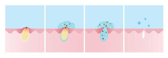 Step of acne pimple treatment process illustration. Apply salicylic acid on skin layer, penetrate into skin to dissolve the dead skin cells clogging pore and decrease redness and swelling. vector