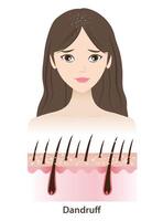 The woman with dandruff on hair illustration isolated on white background. Cross section of white dry flakes, scaly patches on scalp layer. Hair care and problem concept. vector