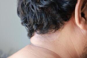 Asian men have a red, itchy, scaly rash skin rash caused by fungus. scalp dermatitis due to moisture-causing fungi. fungal itching. about of skin diseases-allergies, psoriasis, eczema, dermatitis. photo