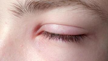 Irritated red blood eye full with capillar net. Conjunctivitis after flu, cold or allergy close-up video