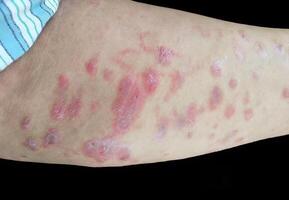 A raised, red, target like rash on the skin or mucous membranes characteristic of erythema multiforme photo