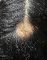 A closeup view of scalp of a woman, revealing a noticeable patch of hair loss due to alopecia photo