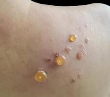 A closeup of skin with multiple fluid filled blisters characteristic of bullous pemphigoid photo