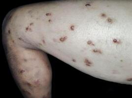 Multiple scattered lesions of varying sizes, some raised and reddish photo