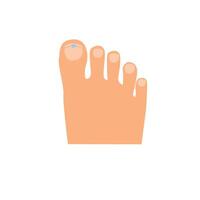 Toes on the right foot with a titanium staple on the thumb for correction of the shape of the toenail cartoon vector