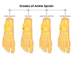 Grades of Ankle Sprin Science Design Illustration Diagram vector