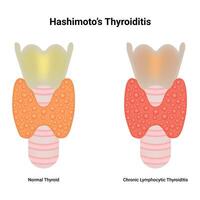 Hashimoro's Thyroiditis Science Design Illustration Diagram vector
