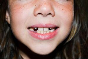 Closeup view of an adorable toddler girl smiling with two of her milk teeth missing. Wide view image. photo