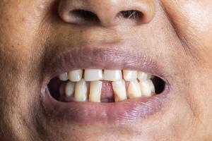 Close up of the teeth of a woman with a broken tooth. photo