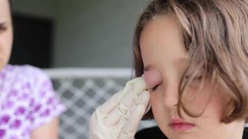 a small childhood infection on the eyelid caused by insect, mosquito or bee bites that causes swelling, redness, heat and itching. Allergy after mosquito bites in a little girl video
