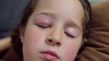 a small childhood infection on the eyelid caused by insect, mosquito or bee bites that causes swelling, redness, heat and itching. Allergy after mosquito bites in a little girl video