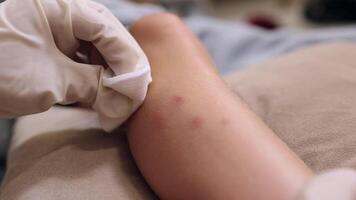 a small skin infection caused by mosquito bites that causes itching and redness. A mother applies cream to a child on the site of a mosquito bite. video