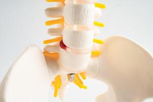 Lumbar spine displaced herniated disc fragment, spinal nerve and bone. Model for treatment medical in the orthopedic department. photo