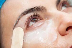 Application of topical anesthesia cream prior to a dermatological procedure. photo