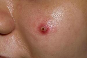 Cystic acne on the face of an Asian patient. Large pustule. photo