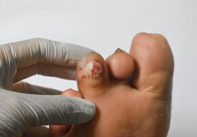 Diabetes foot ulcer of a patient. photo