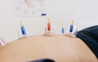 Close-up of suction cups on the patient back, Acupuncture cupping on the back of a person lying down. Patient lying down with suction cups on her back. Physiotherapy cupping on a lying patient photo